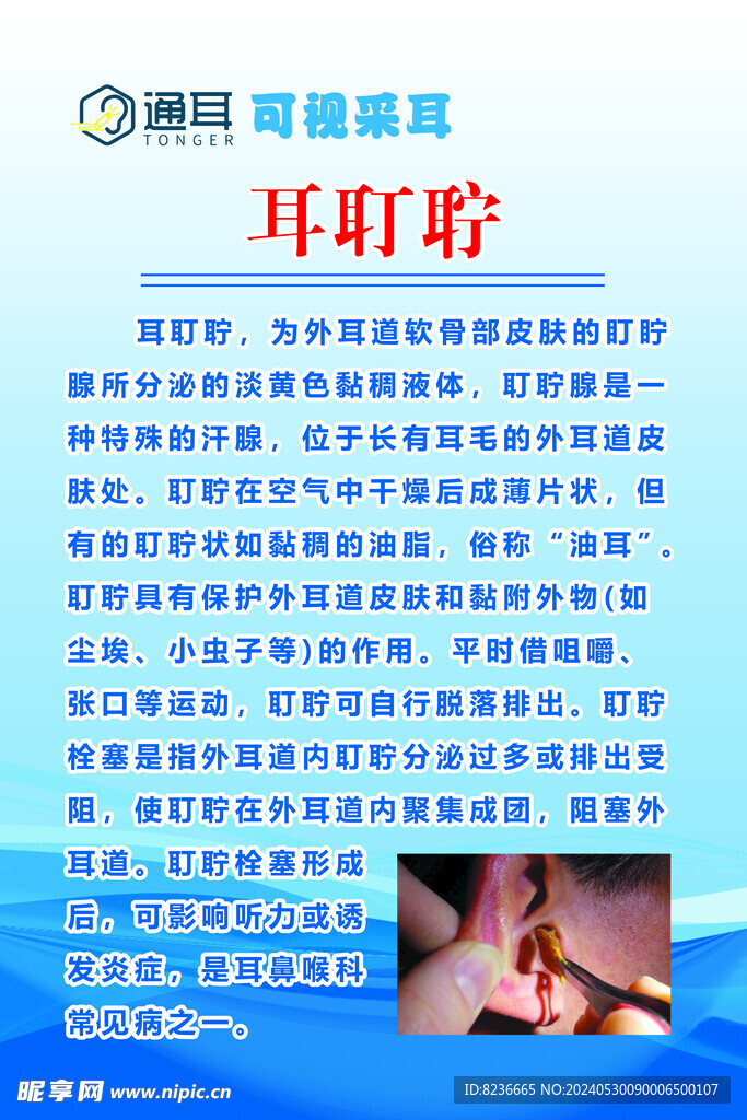 关于耳垢的科普与讨论，耵聍资讯分享